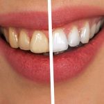 Endodontisch behandelte Zähne